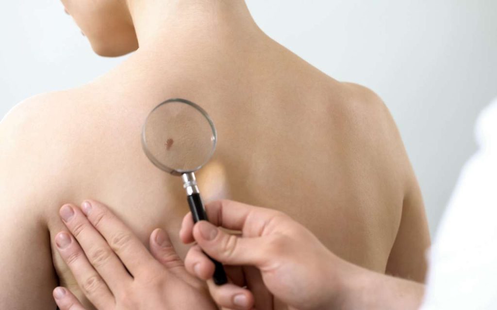 Skin Cancer Check Coomera