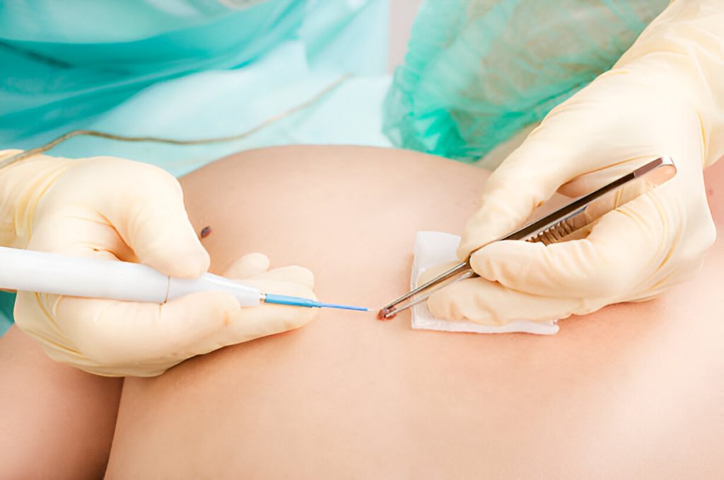 Skin Cancer Centre Runaway Bay