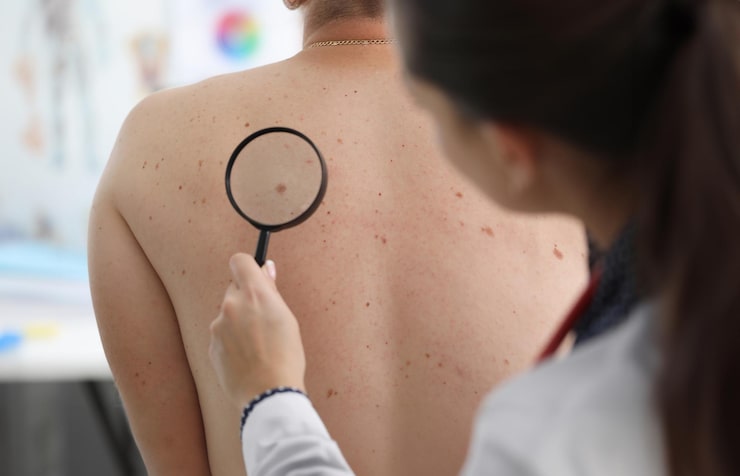 Skin Cancer Check Advancetown